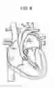 Fig. 09 - Delivery systems and methods for transcatheter prosthetic valves