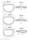 Fig. 02 - Methods of delivering a flexible annuloplasty ring