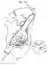 Fig. 03 - Anchor-Delivery Sheath Tip