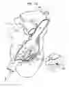 Fig. 04 - Anchor-Delivery Sheath Tip