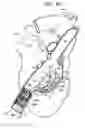 Fig. 07 - Anchor-Delivery Sheath Tip