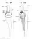 Fig. 32 - Anchor-Delivery Sheath Tip