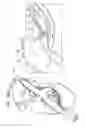 Fig. 50 - Anchor-Delivery Sheath Tip