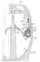Fig. 01 - Expandable heart valve coaptation device