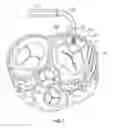 Fig. 08 - Expandable heart valve coaptation device