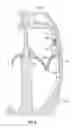 Fig. 09 - Expandable heart valve coaptation device