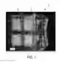 Fig. 02 - Reinforced bone scaffold