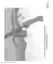 Fig. 07 - Implant for a bone joint