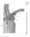 Fig. 09 - Implant for a bone joint