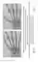 Fig. 12 - Implant for a bone joint
