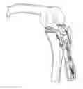 Fig. 01 - Devices and methods to prevent joint instability following arthroplasty