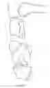 Fig. 06 - Devices and methods to prevent joint instability following arthroplasty