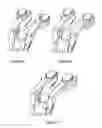 Fig. 07 - Devices and methods to prevent joint instability following arthroplasty