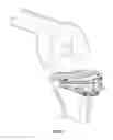 Fig. 08 - Devices and methods to prevent joint instability following arthroplasty