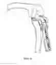 Fig. 09 - Devices and methods to prevent joint instability following arthroplasty