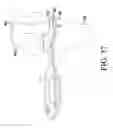 Fig. 33 - Orthopaedic surgical system for determining joint forces of a patient's knee joint