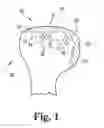 Fig. 02 - Adjustable position trial component with drill guide