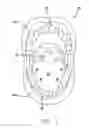 Fig. 02 - Dental Sleep Apnea Device