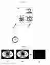 Fig. 05 - Detachable miniature microscope mounted keratometer for cataract surgery