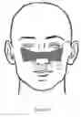 Fig. 10 - Nasal compression device