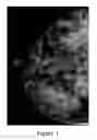 Fig. 02 - Methods of reducing mammographic breast density and/or breast cancer risk
