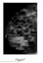Fig. 03 - Methods of reducing mammographic breast density and/or breast cancer risk