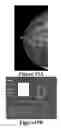Fig. 18 - Methods of reducing mammographic breast density and/or breast cancer risk