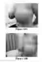 Fig. 22 - Methods of reducing mammographic breast density and/or breast cancer risk