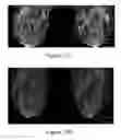 Fig. 24 - Methods of reducing mammographic breast density and/or breast cancer risk