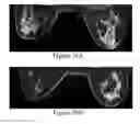 Fig. 27 - Methods of reducing mammographic breast density and/or breast cancer risk
