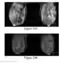 Fig. 28 - Methods of reducing mammographic breast density and/or breast cancer risk