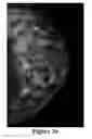 Fig. 35 - Methods of reducing mammographic breast density and/or breast cancer risk