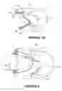 Fig. 22 - Deformable insert for low pressure patient interface