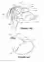 Fig. 33 - Deformable insert for low pressure patient interface
