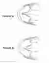 Fig. 41 - Deformable insert for low pressure patient interface