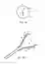 Fig. 41 - Systems and methods for inducing negative pressure in a portion of a urinary tract of a patient