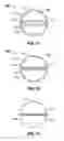 Fig. 06 - Catheter having an expandable lumen and method of manufacture