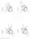 Fig. 06 - Method and devices for passing a chronic total occlusion and re-entry into a true lumen
