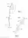 Fig. 02 - Ureteral stent