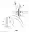 Fig. 03 - Vacuum assisted percutaneous appliance