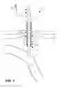 Fig. 04 - Vacuum assisted percutaneous appliance