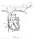 Fig. 02 - Balloon catheter suturing systems, methods, and devices having pledgets
