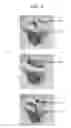 Fig. 07 - Ergonomic stool specimen container and enclosing holder systems, methods, and kits