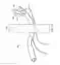 Fig. 44 - Surgical instrument for manipulating and passing suture
