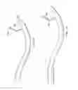 Fig. 45 - Surgical instrument for manipulating and passing suture