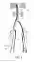 Fig. 02 - FLOW RATE CONTROL DEVICE FOR VARIABLE ARTERY OCCLUSION