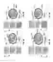 Fig. 04 - LEFT ATRIAL APPENDAGE OCCLUDER DEVICE
