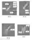 Fig. 07 - LEFT ATRIAL APPENDAGE OCCLUDER DEVICE