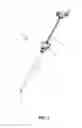Fig. 02 - Single incision laparoscopic tissue retrieval system