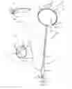 Fig. 02 - Thrombectomy catheter and methods of use